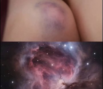 A side-by-side comparison shows a purple bruise on someone's skin on top and a similarly colored purple nebula in space on the bottom, highlighting their visual resemblance.