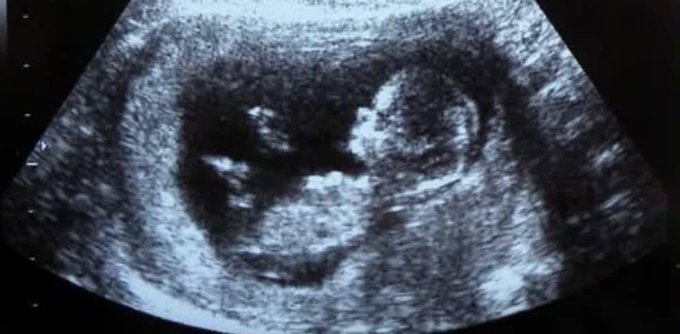A grayscale medical ultrasound image showing the curved shape of a fetus in the womb.
