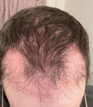 A close-up of a person's scalp showing thinning hair with a visible receding hairline at the crown and temples. The image relates to the post by illustrating a person involved in the "desci" (decentralized science) project on Ethereum, possibly highlighting how the topic resonates with the community member shown.