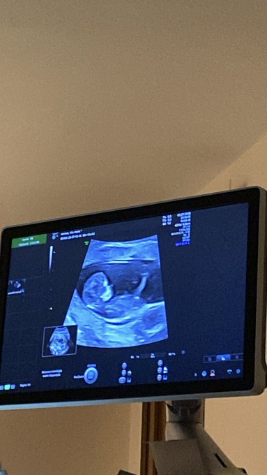 A medical ultrasound monitor displaying a fetal scan image, mounted on a stand in what appears to be a clinical room with beige walls.