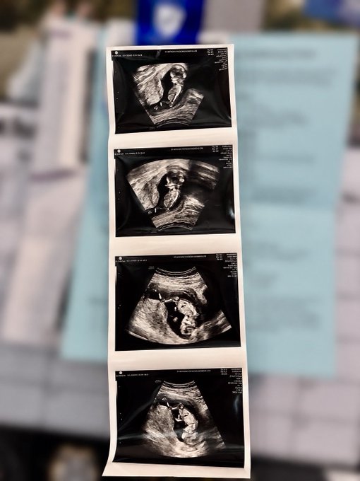 Four ultrasound images printed on a strip lay atop medical paperwork, showing the developing fetus in her first glimpses ahead of becoming a dad.