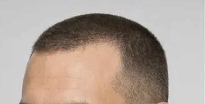 A close-up of a man's forehead showing a receding hairline, which the caption jokes is the result of "Polymarket and crypto." The image humorously illustrates the "McDonald's hairline" he mentions while sharing his new regimen of finasteride and minoxidil.