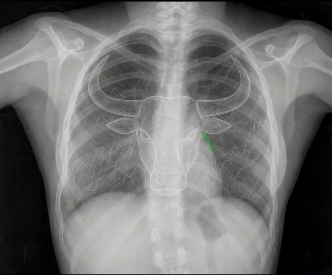 A chest X-ray showing a bull's head outline overlaid on the ribcage with a green annotation arrow.