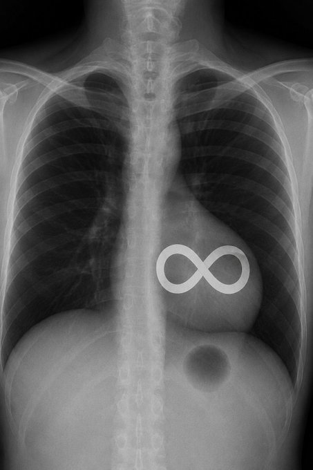 A chest X-ray features an infinity symbol (∞) overlaid on the heart, visually illustrating the concept of eternal or infinite love—matching the post declaring endless love for the $ICP ticker.