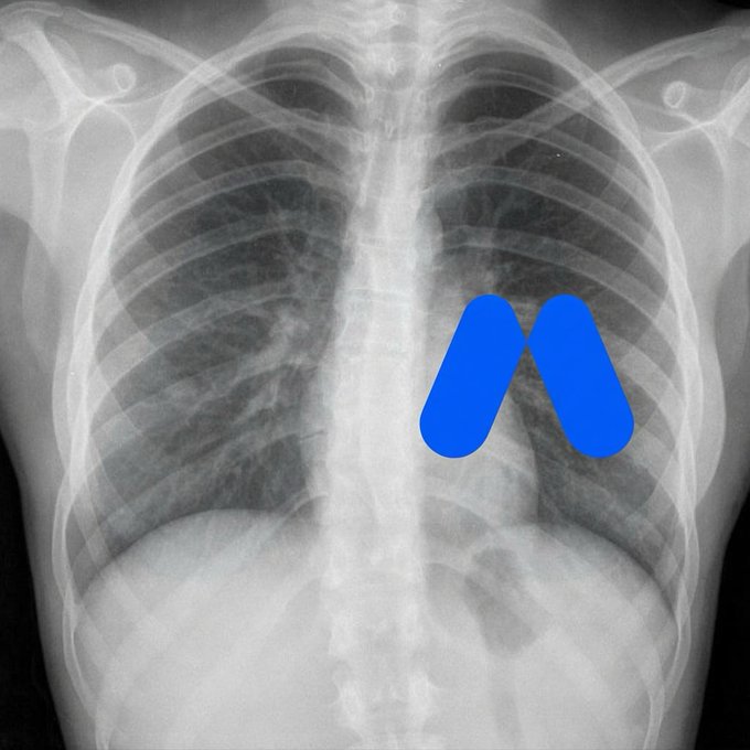 A chest X-ray with the XRP cryptocurrency logo superimposed over the right lung area.