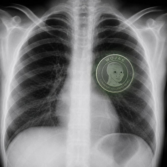 A chest X-ray with a cryptocurrency coin labeled 'WOJAK' (with text 'COMMUNITY - CULTURE - MEMES') overlaid on the right lung area.