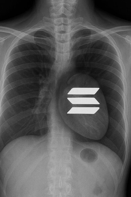 A chest X-ray (radiograph) showing the ribcage, lungs, and heart, with a white Solana (SOL) logo overlaid on the heart area as a meme reference to 'Solana lungs.'