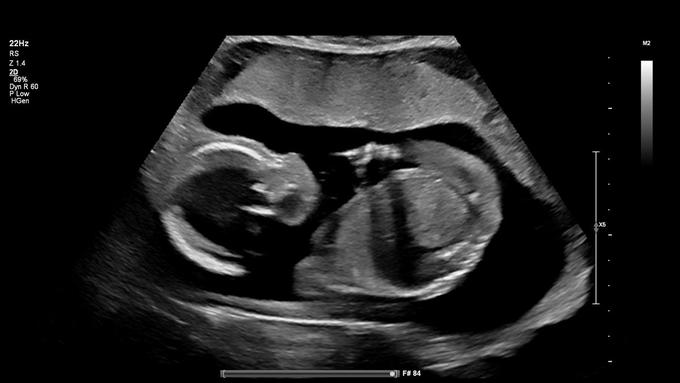 A black and white prenatal ultrasound image showing a fetus.