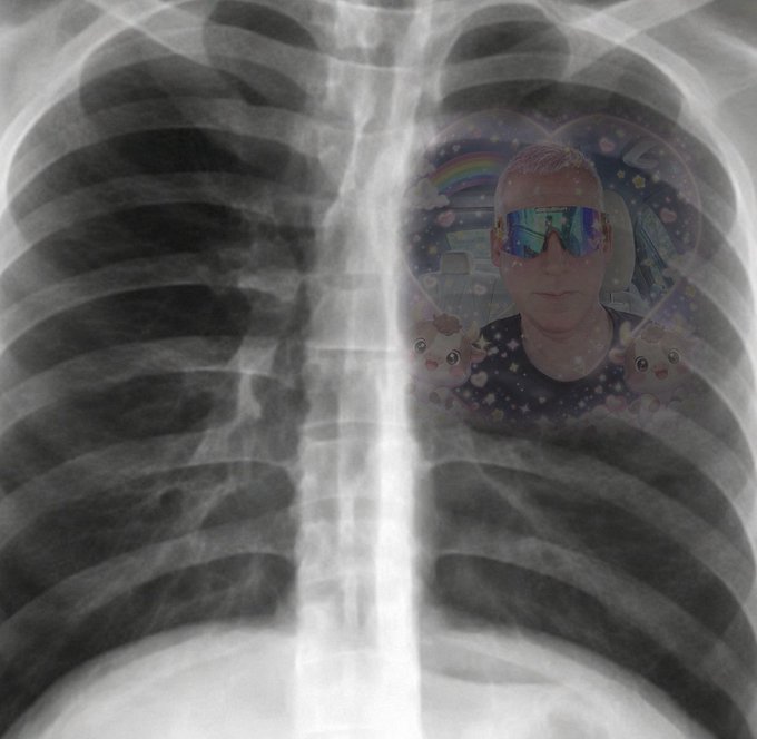 Chest X-ray image with a small inset photo of a man wearing reflective sunglasses placed over the left lung area, decorated with rainbow and cartoon stickers.