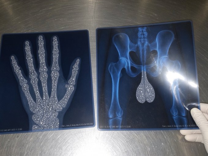 Two X-ray images displayed on a metallic surface: one shows a hand with visible bones, and the other displays a pelvic region with a glittery, decorative overlay covering part of the anatomy.