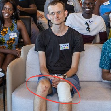 A man wearing a black 'VITALS' t-shirt sits on a couch with a bandaged left knee and a scraped right knee highlighted by a red oval, flanked by smiling people.