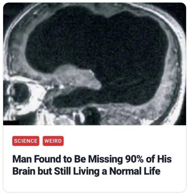 A news article screenshot with an MRI brain scan and headline 'Man Found to Be Missing 90% of His Brain but Still Living a Normal Life', tagged with 'SCIENCE' and 'WEIRD'.