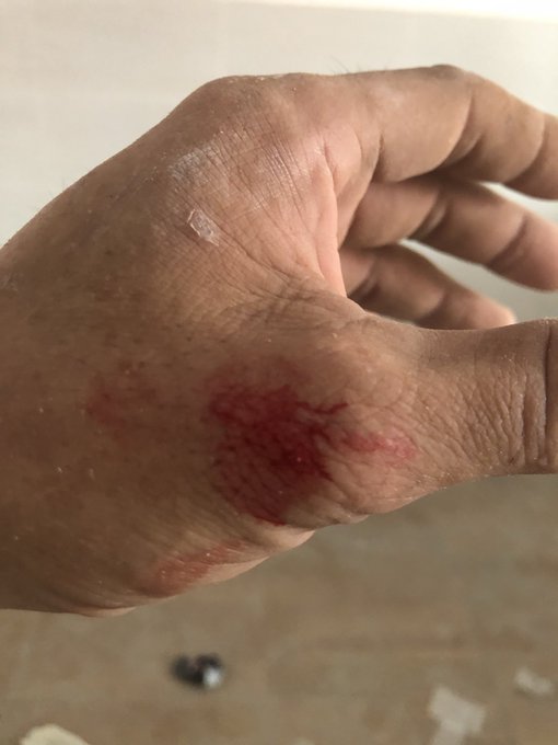A close-up photograph shows a person's hand with a red, irritated rash or abrasion on the back of it.