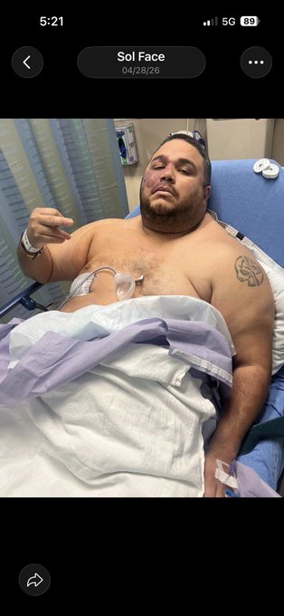 iPhone screenshot showing a photo dated 04/28/26 of someone recovering in a hospital bed with visible facial injuries and a black eye, with the album labeled 'Sol Face'.