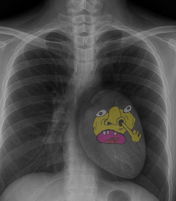 A chest X-ray image showing a cartoon face of a sickly character (resembling a yellow emoji picking its nose) overlaid on the heart area, humorously representing the "pumping" or launching of new meme coins as a medical/contest theme.

The image doesn't display any text, numbers, or tickers directly, but its meme-style artwork aligns with the post's Pump.fun contest announcement, using the humorous "sick heart" imagery to playfully represent the excitement and energy of upcoming crypto contests and rewards.