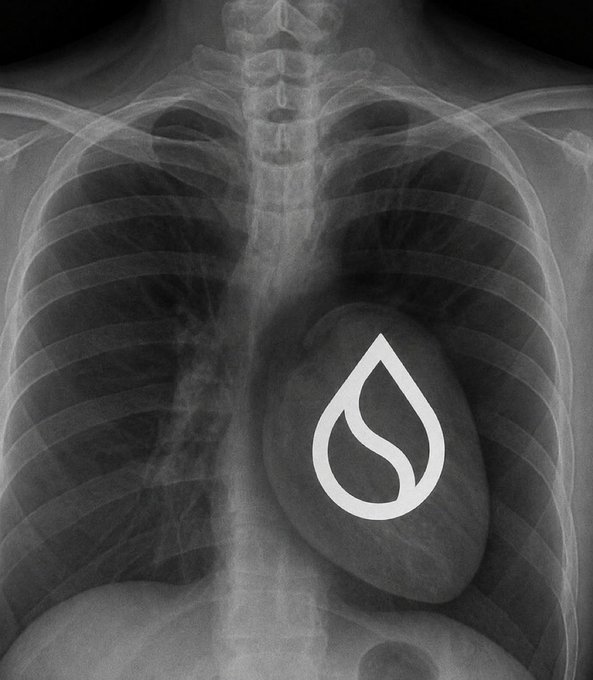 A chest X-ray with a stylized white teardrop/water drop logo overlaid on the heart area, showing the ribcage and spine in grayscale.