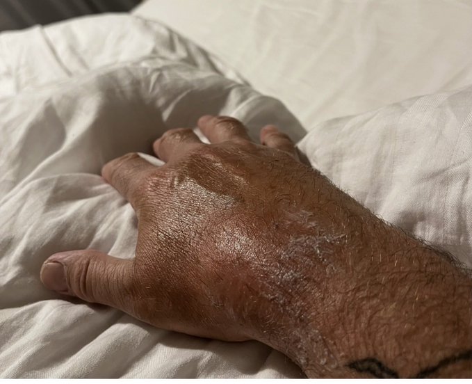 A close-up photo of a hand resting on white bed sheets, showing what appears to be a white powdery residue or substance spread across the back of the hand.