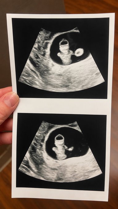 A hand holds two ultrasound photos showing a small fetus, appearing to be early pregnancy images.