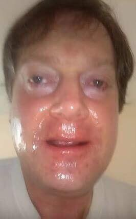 A close-up photo shows a man's severely sunburned, shiny, and peeling face.