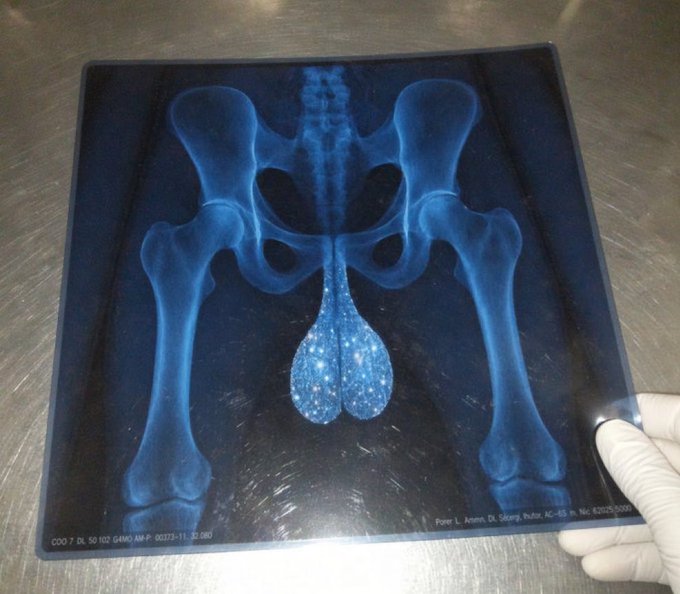 An X-ray image of a human pelvis showing the hip bones, sacrum, and what appears to be a decorative blue sequined testicle-shaped object overlaid between the legs, held by a gloved hand.