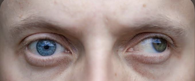 A close-up photograph of a person's eyes, with the left eye being blue and the right eye being a greenish-hazel color, illustrating heterochromia.