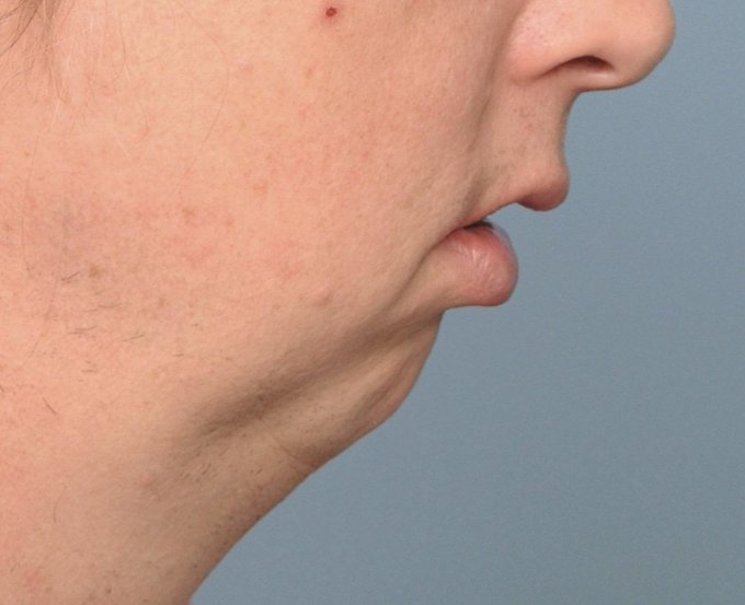 A close-up side profile of a person's lower face showing their chin and mouth, with a neutral gray background. The image visually complements the post's commentary about bear markets, with the downturned mouth and shadowed chin area serving as a visual metaphor for the grim, sober expressions often seen during market downturns.