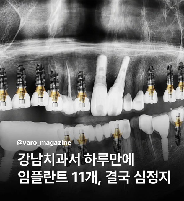 A dental panoramic X-ray overlaid with illustrations of numerous dental implants, accompanied by Korean text reading "@varo_magazine" and "강남치과서 하루만에 임플란트 11개, 결국 심정지" (translation: "11 implants in one day at a Gangnam dental clinic, ultimately cardiac arrest"). The image directly illustrates the post's alarming claim of a Gangnam dental clinic performing excessive implant procedures in a single day, with the caption suggesting these unethical practices are akin to "torture" by quack dentists exploiting patients.