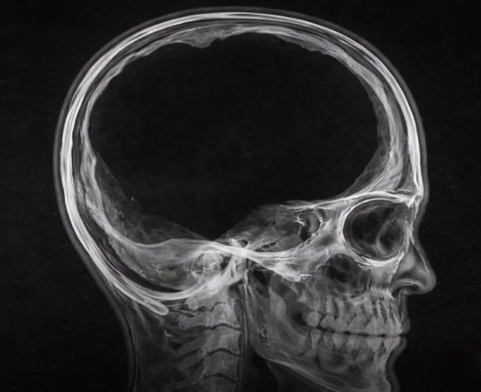 A lateral skull X-ray showing an unusually large, fluid-filled cranial cavity with minimal brain tissue visible, illustrating the extraordinary medical case of a 25-year-old man whose skull was almost entirely filled with fluid, yet who lived a normal life as a crypto trader with a wife and children.
