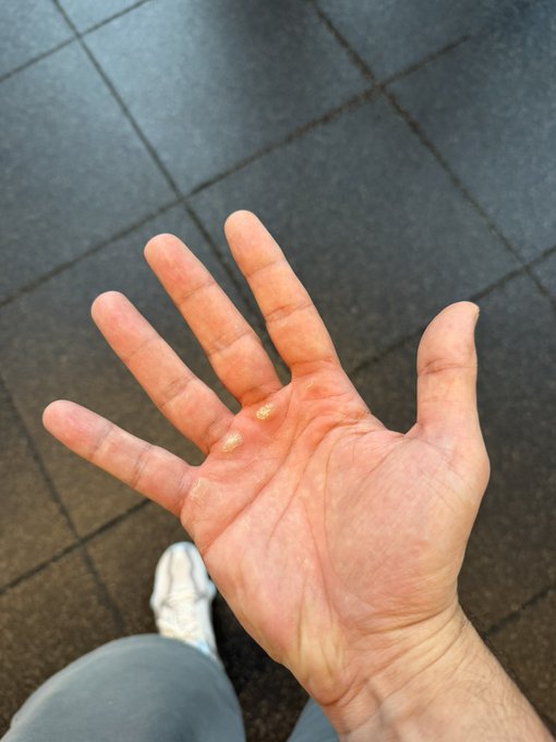 A close-up photo of an open palm showing what appears to be small blisters or skin irritation on the fingers, taken over a tiled floor with the photographer's shoe visible.