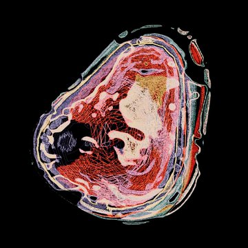 A cross-sectional medical scan, likely an MRI or CT, showing anatomical structures in vibrant colors against a black background.