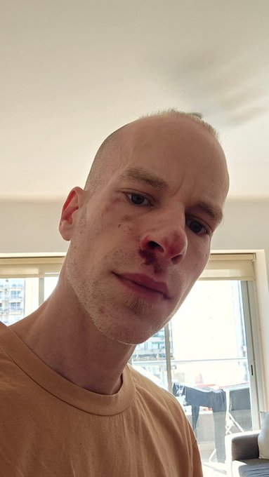 A young man with a shaved head and stubble takes a close-up selfie showing visible bruising and a bloody/injured nose and lip area, standing in a brightly lit room with windows behind him. The image directly illustrates his message about a rough night and his temporarily "fucked up" face, capturing the aftermath of whatever incident caused his injuries.