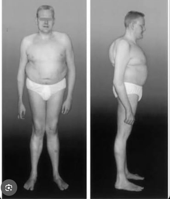 A clinical before-and-after medical photo showing an overweight man in front and profile views, displayed in grayscale as a documentary comparison. The image humorously matches the post's concern about health, depicting noticeable weight loss between the comparison shots.