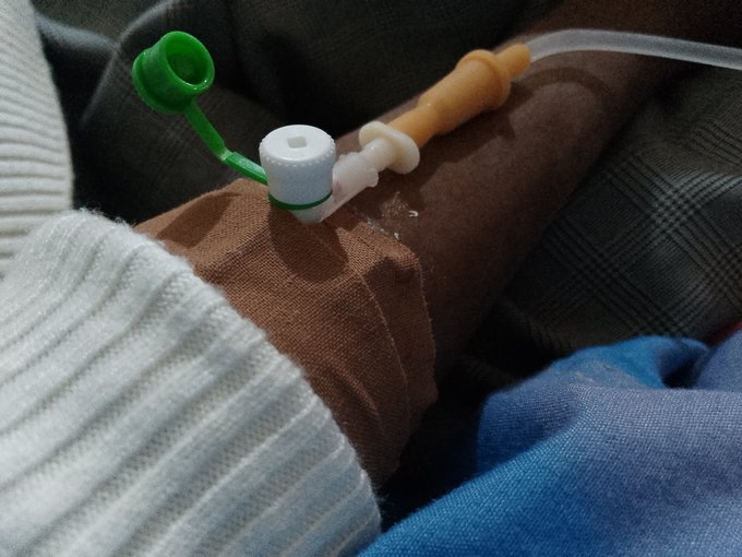 Close-up of a medical catheter or similar device with green, white, and orange plastic connectors taped to a person's arm over a white sock.