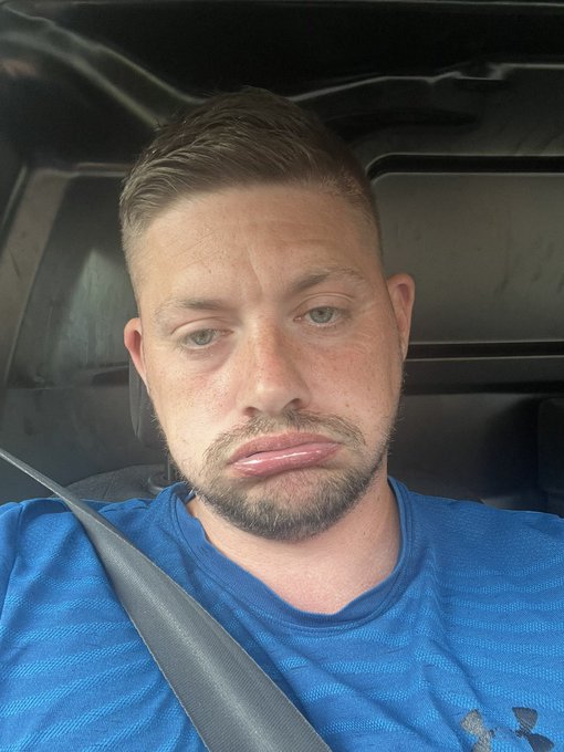 A man with short brown hair and a beard sits in a car wearing a blue t-shirt and seatbelt, with prominent swollen lips.