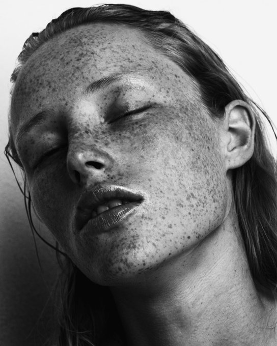 A black-and-white close-up portrait of a person with closed eyes and many freckles across their face.