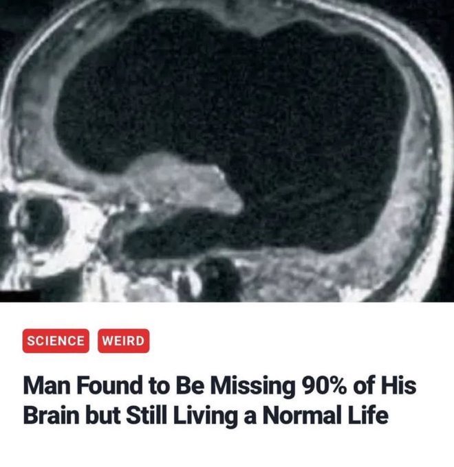 An MRI brain scan with a headline reading 'Man Found to Be Missing 90% of His Brain but Still Living a Normal Life' tagged under SCIENCE and WEIRD categories.