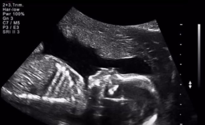 The image shows a medical scan, possibly an ultrasound or CT scan, of a baby's head with its body visible as well. The scan appears to be black and white, which might make it difficult to read certain details. The caption provided seems unrelated to the image itself but includes some text that is not clear from the image alone. It reads: "Me in 2009 wasting time instead of coming out to buy bitcoin". This phrase does not seem to have any direct connection with the medical scan or the baby's head, and it might be a distraction for viewers who are trying to understand the content of the image.