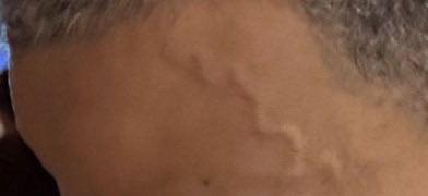 A closeup of an unusual tattoo or vein located on someone's head, with a grey background that emphasizes its prominence. In the foreground, there is also text present - either at the top of the image or bottom right corner. The text indicates that there are fees for this particular procedure and the process of removing it may take several sessions to be fully completed.