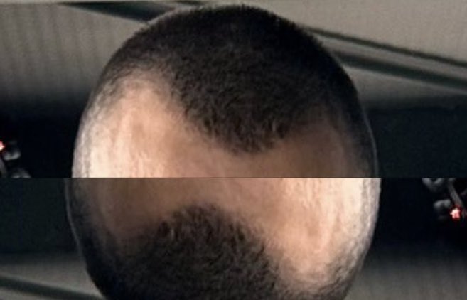 A top-down view of a man's scalp showing a pattern of hair loss that resembles a logo or symbol, with the post humorously noting that the unique shape wasn't made into a meme on Hyperliquid.