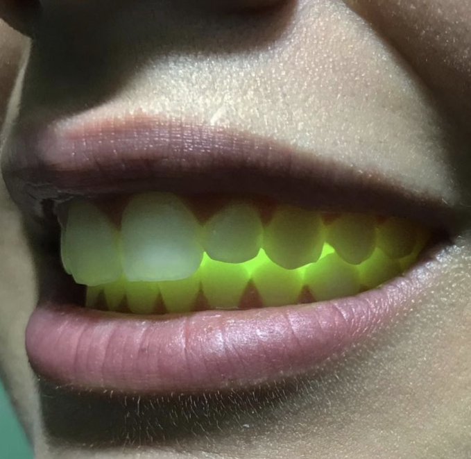 A close-up photo of a person's mouth with lips slightly parted, revealing teeth that glow with a bright neon green/yellow fluorescent light.