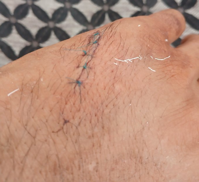 Close-up of a person's hairy hand showing a fresh surgical incision closed with blue sutures.