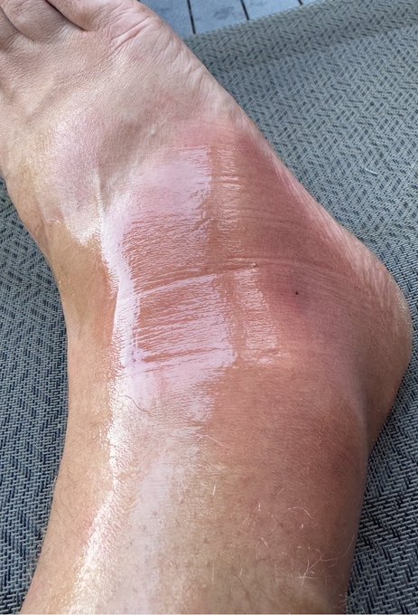 A swollen, glossy ankle rests on a gray woven surface, the skin taut and shiny from apparent inflammation. The image pairs with the exhausted caption "I'm tired boss," conveying the weariness and frustration of dealing with a painful, lingering injury.