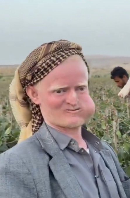 A video still showing a man with a swollen or enlarged face wearing a gray suit jacket, gray shirt, and a patterned keffiyeh/headscarf. He stands in an outdoor field setting with another person visible in the background.