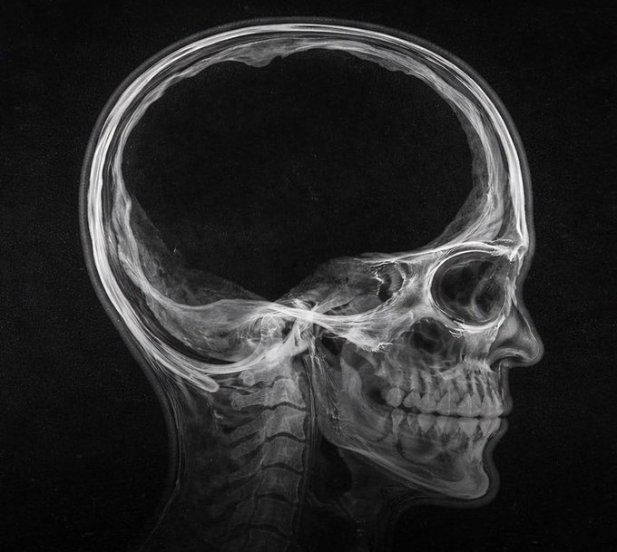 A black and white X-ray image shows a side profile view of a human skull, revealing an unusually large cranial cavity and teeth.
