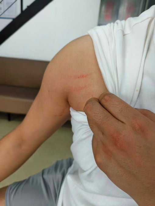 A hand pinches and pulls at a red scrape or wound on a person's upper arm, visible against their white shirt, suggesting an injury sustained during a physical altercation. The image visually represents the creditors being physically harmed or roughed up while demanding answers from Sheldon Xia's father over the BitMart withdrawal issues.