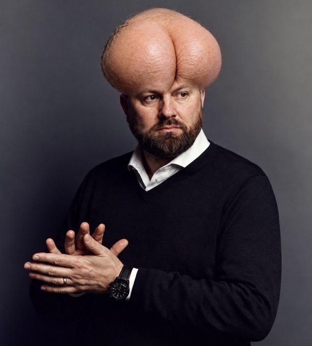 A man with a beard, wearing a black sweater over a white collared shirt, stares seriously at the camera while an exaggeratedly large, bulbous swelling sits atop his bald head.