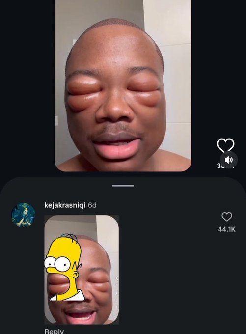 A social media screenshot from user 'kejakrasniqi' showing a man with a very swollen face, and a reply featuring the Simpsons character Bart Simpson edited next to the swollen face.