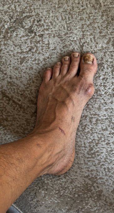 A close-up of a bare foot with visible scars and a discolored toenail rests on a carpeted floor. The image illustrates the post's reference to "BITFOOTS," symbolically affirming the author's sense of wear and perseverance through visible physical marks.