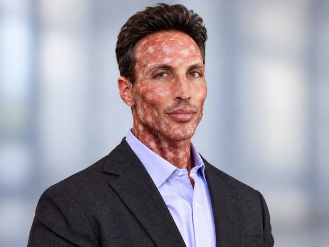 A professional portrait of a man in a dark suit and light blue shirt with noticeable red, irritated skin patches across his face and neck, set against a blurred office background.