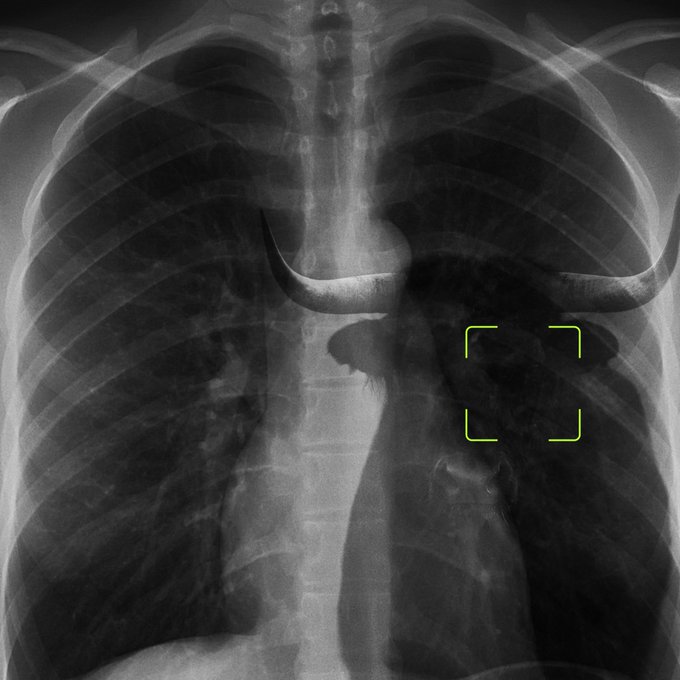A chest X-ray showing the ribcage, lungs, and heart, with a yellow targeting bracket highlighting the cardiac silhouette on the left side of the chest (right side of the image). The bracketed area emphasizes the heart, tying into the "bull in me" caption as a playful nod to bullish market enthusiasm centered on the chest/heart region.